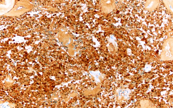 18C Ependymoma, myxopapillary (Case 18)_004 S100 10X