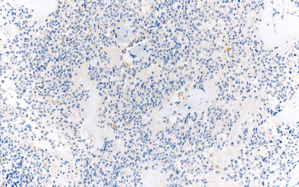 18D Ependymoma, myxopapillary (Case 18)_004 EMA 20X