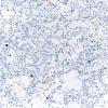 18E Ependymoma, myxopapillary (Case 18)_004 Ki67 20X