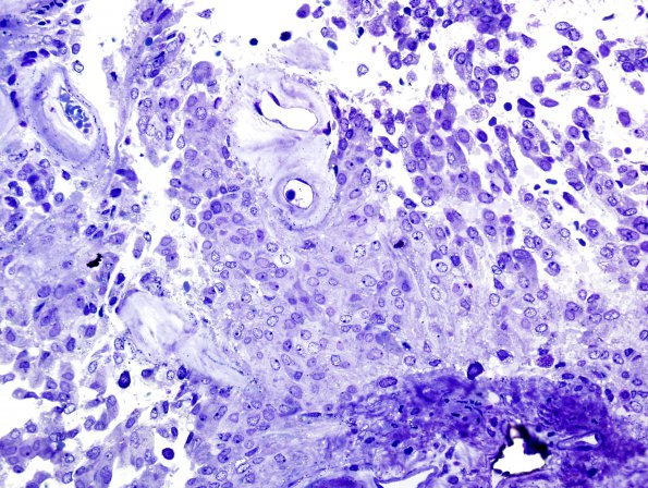 18F Ependymoma, myxopapillary (Case 18) Plastic 1