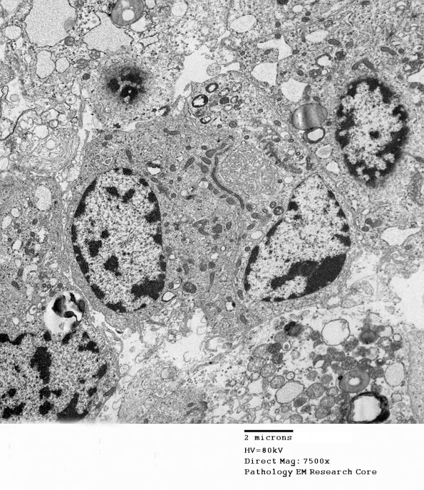 18G2 Ependymoma, myxopapillary (Case 18)_006 - Copy - Copy