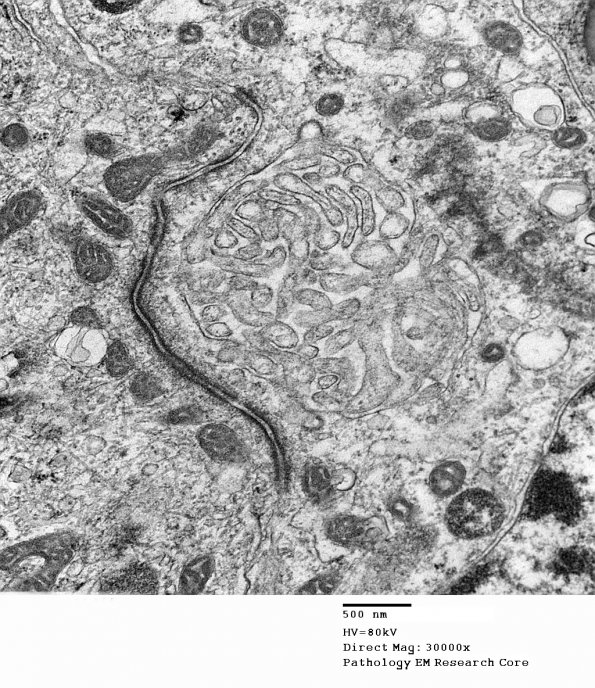 18G3 Ependymoma, myxopapillary (Case 18)_004 - Copy - Copy