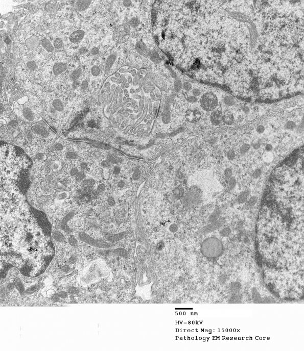 18G4 Ependymoma, myxopapillary (Case 18)_012 - Copy - Copy