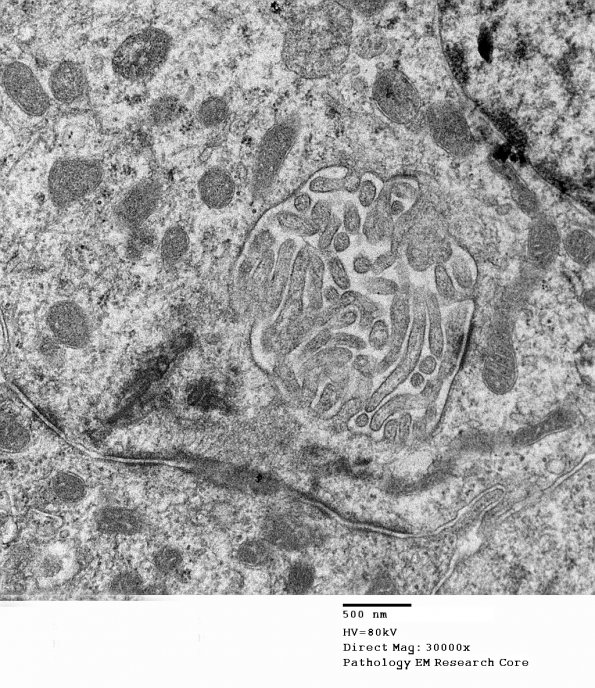 18G5 Ependymoma, myxopapillary (Case 18)_013 - Copy - Copy