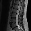 1A Ependymoma, myxopapillary (Case 1) T2 1 - Copy