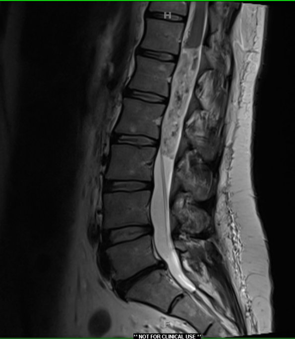 1A Ependymoma, myxopapillary (Case 1) T2 1 - Copy