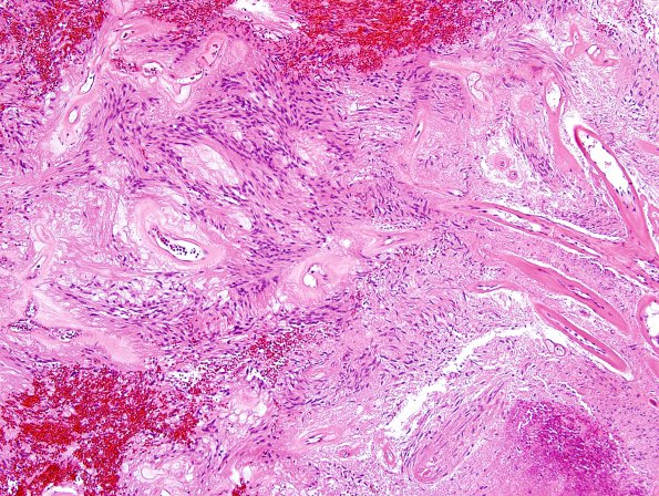 1B1 Ependymoma, myxopapillary (Case 1) H&E 6.jpg