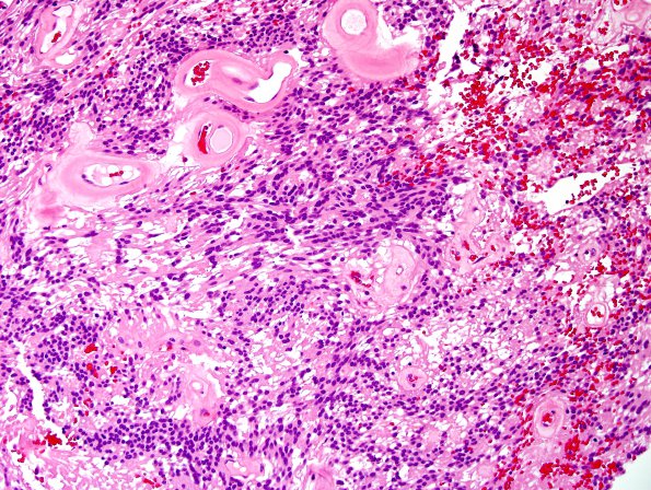 1B2 Ependymoma, myxopapillary (Case 1) H&E 1.jpg