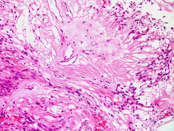 1B3 Ependymoma, myxopapillary (Case 1 H&E 5.jpg