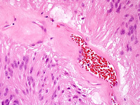 1B4 Ependymoma, myxopapillary (Case 1) H&E 4.jpg