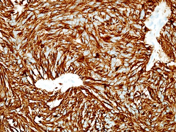 1C Ependymoma, myxopapillary (Case 1) GFAP 1.jpg