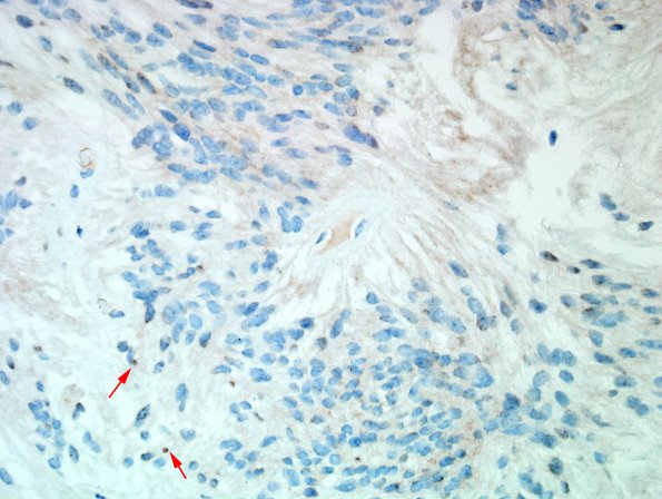 1D Ependymoma, myxopapillary (Case 1) D2-40 1 copy.jpg