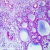 1E Ependymoma, myxopapillary (Case 1) Alcian blue PAS 2.jpg