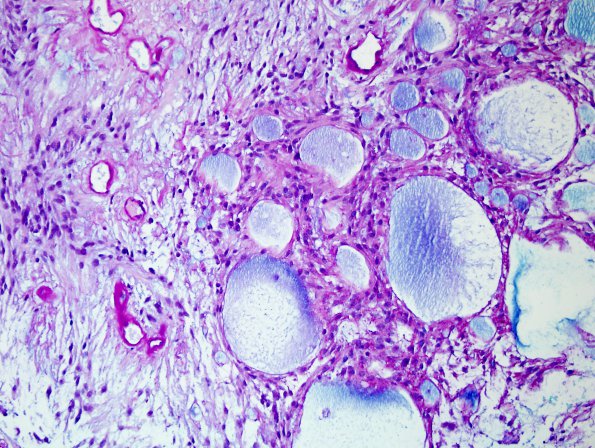 1E Ependymoma, myxopapillary (Case 1) Alcian blue PAS 2.jpg