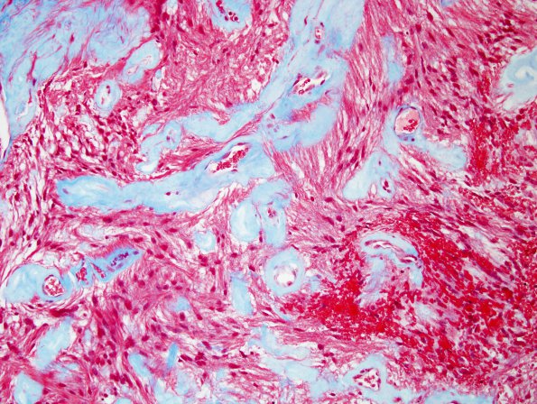 1F1 Ependymoma, myxopapillary (Case 1) Trichrome 1.jpg