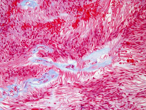 1F2 Ependymoma, myxopapillary (Case 1) Trichrome 3.jpg