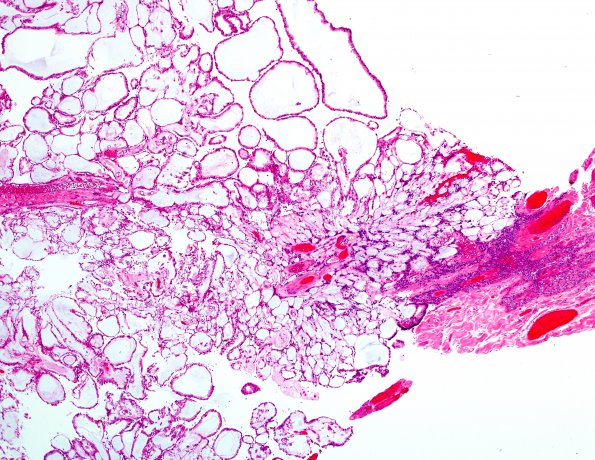 20A2 Ependymoma, myxopapillary (Case 20) H&E 1.jpg