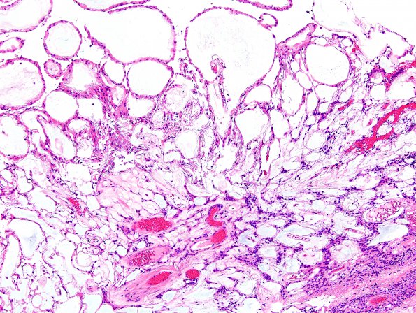 20A3 Ependymoma, myxopapillary (Case 20) H&E 2.jpg