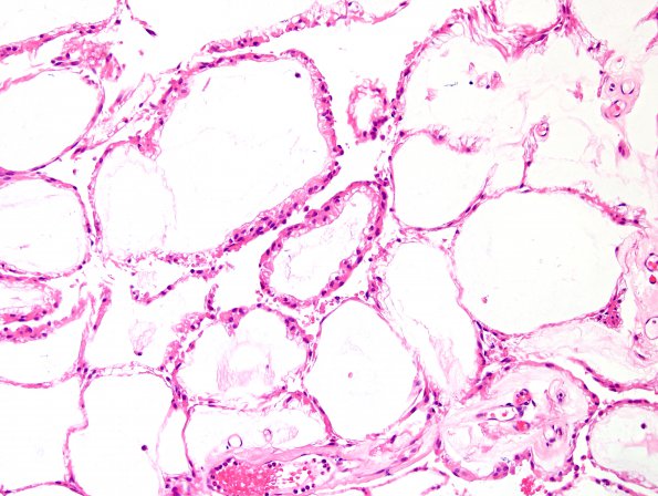 20A4 Ependymoma, myxopapillary (Case 20) H&E 3.jpg