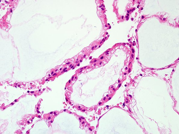 20A5 Ependymoma, myxopapillary (Case 20) H&E 4.jpg