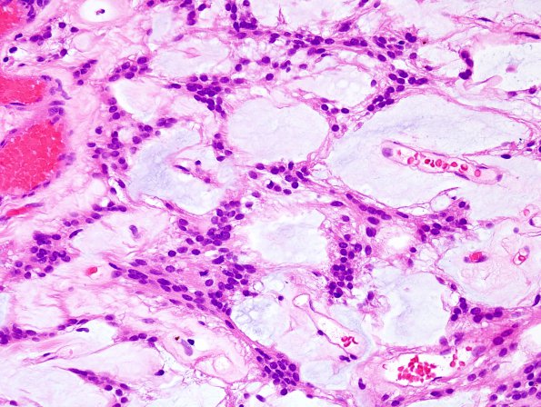 20A6 Ependymoma, myxopapillary (Case 20) H&E 5.jpg