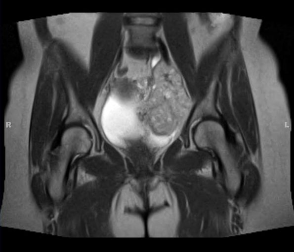 21A Ependymoma, myxopapillary, Anaplastic (Case 20) T2 - Copy