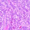 21B1 Ependymoma, myxopapillary ANA (Case 21) 5.jpg