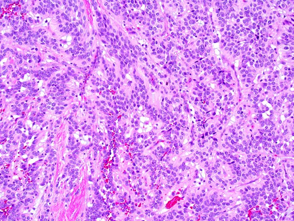 21B1 Ependymoma, myxopapillary ANA (Case 21) 5.jpg