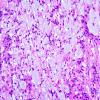 21B2 Ependymoma, myxopapillary ANA (Case 21) 2.jpg