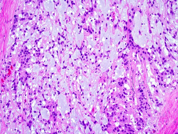 21B2 Ependymoma, myxopapillary ANA (Case 21) 2.jpg