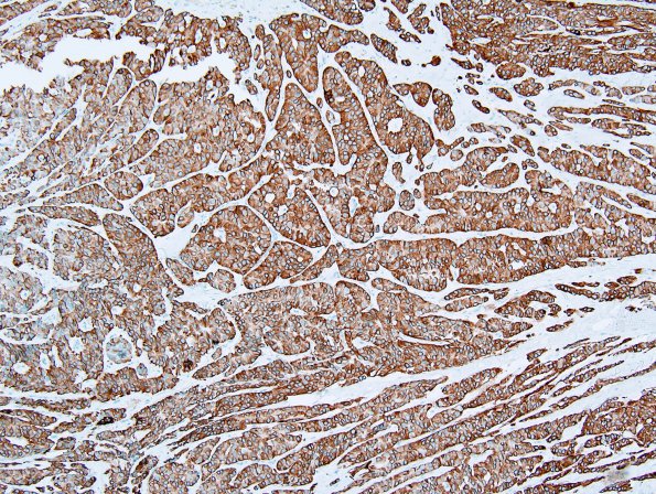 21C1 Ependymoma, myxopapillary ANA (Case 21) GFAP 2.jpg