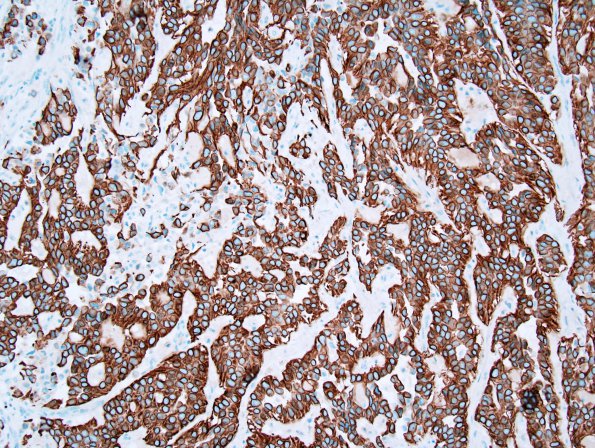 21C2 Ependymoma, myxopapillary ANA (Case 21) GFAP 3.jpg