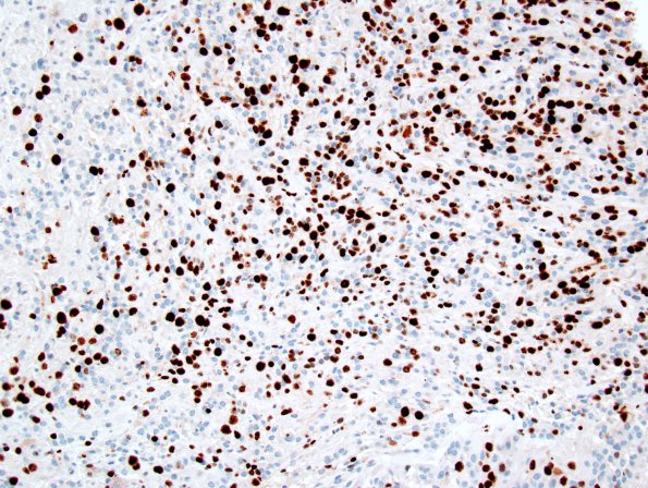 21D1 Ependymoma, myxopapillary ANA (Case 21) Ki-67 1.jpg