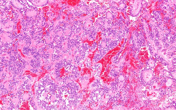 22A1 MPE (Case 22) H&E 10X 1