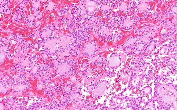 22A2 MPE (Case 22) H&E 20X 1