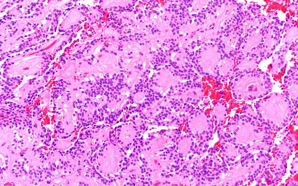 22A3 MPE (Case 22) H&E 20X 2