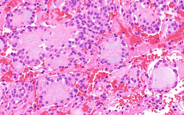 22A4 MPE (Case 22) H&E 40X 1