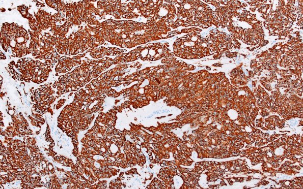 22B1 MPE (Case 22) GFAP 10X 2