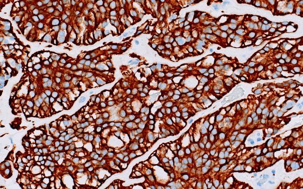 22B3 MPE (Case 22) GFAP 40X 2