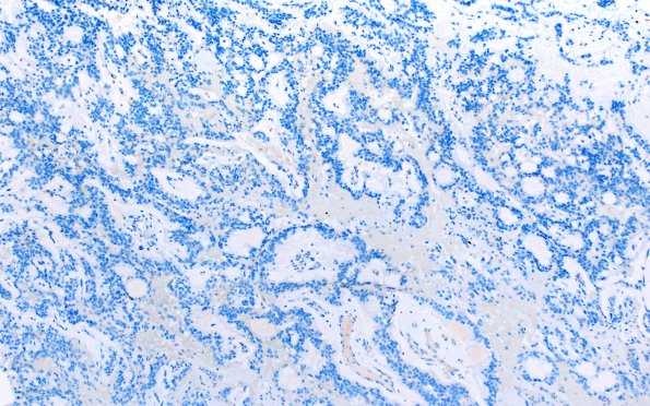 22C MPE (Case 22) Olig2 10X 2