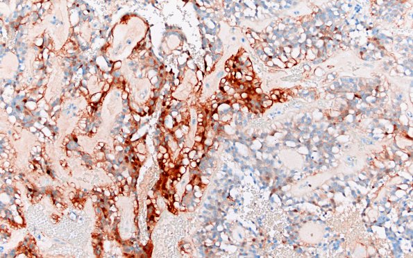 22D MPE (Case 22) S100 20X 2