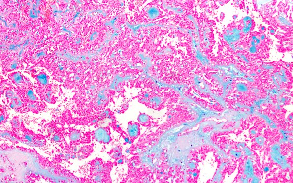 22E1 MPE (Case 22) Alcian Blue 10X