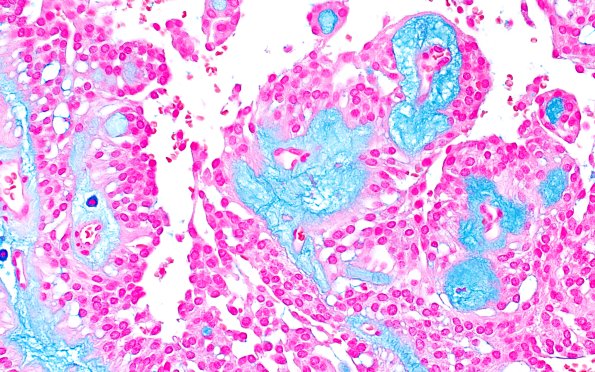 22E2 MPE (Case 22) Alcian Blue 40X