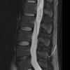 2A1 MPE (Case 2) STIR T2 - Copy