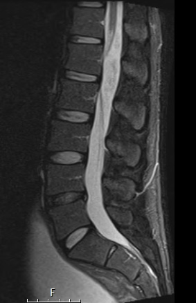 2A1 MPE (Case 2) STIR T2 - Copy