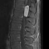 2A3 MPE (Case 2) T1 with Contrast - Copy