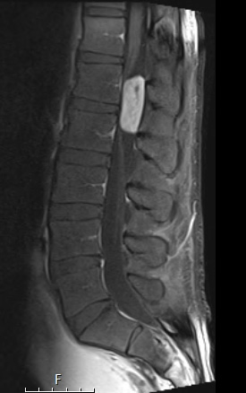 2A3 MPE (Case 2) T1 with Contrast - Copy