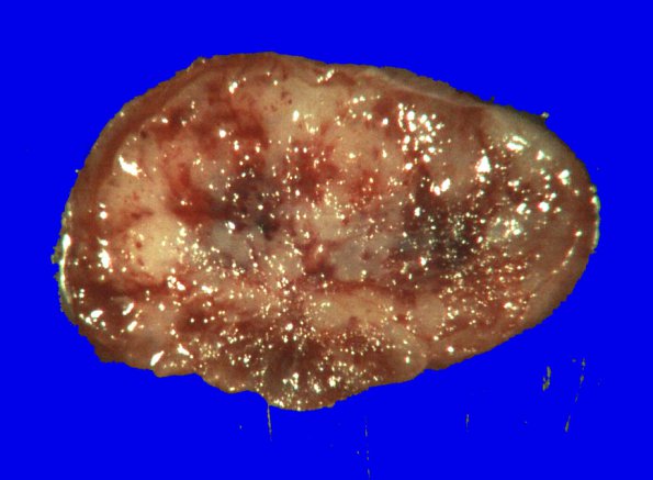 2B2 Ependymoma, myxopapillary (Case 2) Gross _4