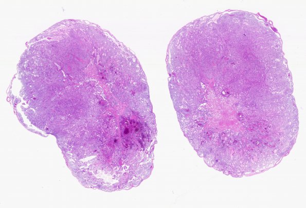 2C1 Ependymoma, myxopapillary (Case 2) H&E WM