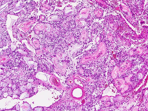 2C2 Ependymoma, myxopapillary (Case 2) H&E 1.jpg